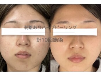 ライフサロン 恵比寿(Life Salon)/本格的肌質改善