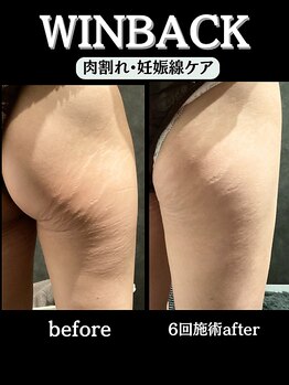 ノーブルノアール(Noble noir)/諦めないで!妊娠線&肉割れ