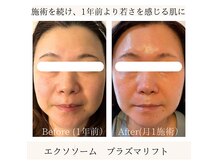 プラズマで浸透力を高め、幹細胞と美容液を導入。細胞を活性化！