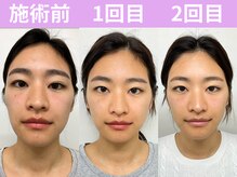 ナチュラルパーフェクトフェイス 新宿/初回～2回目