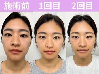 ナチュラルパーフェクトフェイス 新宿/初回~2回目