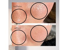 毛穴の開き・汚れにアプローチ!大人気のお施術です◎5回目の効果