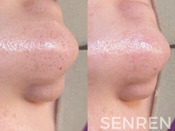 センレン(SENREN)の写真/毛穴の黒ずみにはフェイシャルワックスを