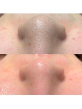 ディオーネ 岡崎店(Dione)/【韓国式３D毛穴洗浄】