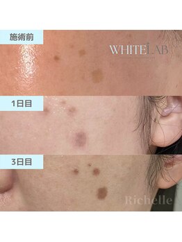 リシェル(Richelle)/【WHITELAB☆はがれるシミケア】