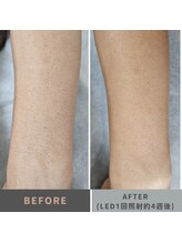 キムラケ 和光別邸(木村家 KIMURAKE)/メンズ脱毛　腕ビフォーアフター