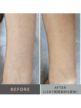 キムラケ 和光別邸(木村家 KIMURAKE)/メンズ脱毛　腕ビフォーアフター