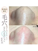 ソマリ(SOMALI)/【毛穴洗浄＆ヒト幹導入】