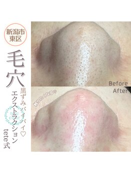 ソマリ(SOMALI)/【毛穴洗浄&ヒト幹導入】