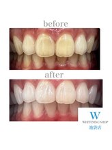 ホワイトニングショップ 仙台店/【ビフォーアフター】美白
