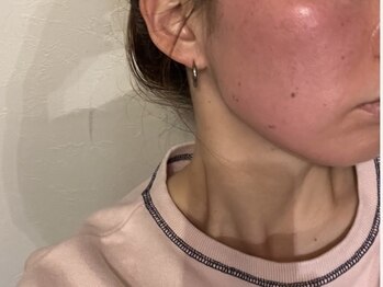 アトワ(A toi)/ハーブピーリングのダウンタイム