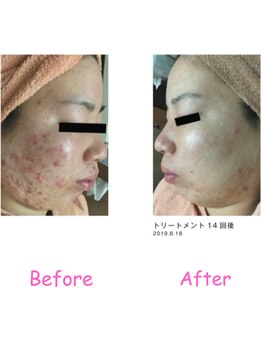 エーエスビューティーサロン(AS Beautysalon)/エクスビアンス　before/after