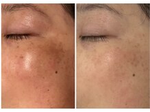 リュウ鍼灸院 サロン ド リュウ(Salon de Ryu)/シミケアでの改善例