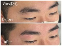 フルミー(fulme.)/WAX脱毛before＆after