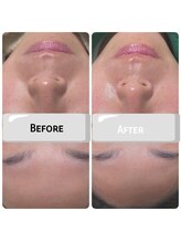 アイドット(i...)/フェイシャルビフォーアフター♪