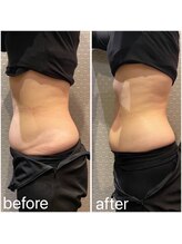 ビュウナ 銀座(BEAUNA)/脂肪冷却/frozen8