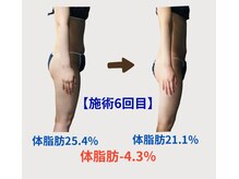 ネオボディ(Neo Body)の雰囲気（2種類の痩身機器＋ハンドの施術で見た目もスッキリ！1.5ヶ月後）