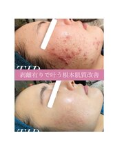 ミエル(miel)/【ハーブピーリング】ニキビケア