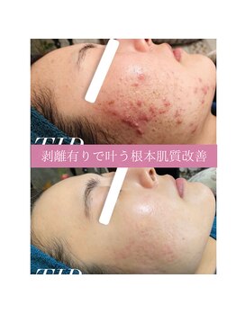 ミエル(miel)/【ハーブピーリング】ニキビケア