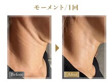 《ミコステラ/モーメント1回》年齢を感じやすい首のケアにも◎