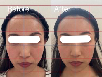 ヘレフア(Hele Hua)の写真/≪NewOpen≫左右差やエラ張りの悩みも解消!痛みの少ない!"造顔技術"で理想のフェイスラインを◎新琴似/麻生