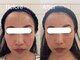 ヘレフア(Hele Hua)の写真/≪NewOpen≫左右差やエラ張りの悩みも解消!痛みの少ない!"造顔技術"で理想のフェイスラインを◎新琴似/麻生
