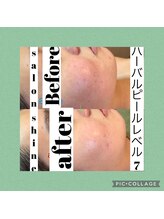 サロンシャイン(Salon Shine)/ハーバルピールレベル７