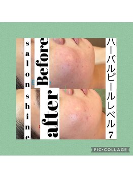 サロンシャイン(Salon Shine)/ハーバルピールレベル７