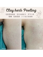 スリジエ ボーテ(cerisierBEAUTE)/施術1回：毛孔性たいせん,サメ肌