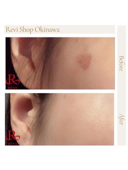 ルヴィショップ 沖縄(REVI SHOP)/REVI陶肌トリートメント