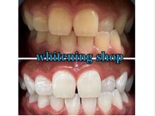 ホワイトニングショップ 鳥取店/ホワイトニングビフォーアフター