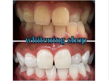 ホワイトニングショップ 鳥取店/ホワイトニングビフォーアフター