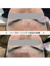 ディアー(Dear)/REVI 陶肌トリートメント