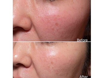 リュミエール デスポワール(Lumiere d'espoir)/原液100%臍帯幹細胞