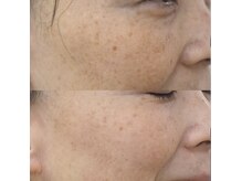 エクレクティック(ECLECTIC)/小顔/シミケア/宇都宮エステ