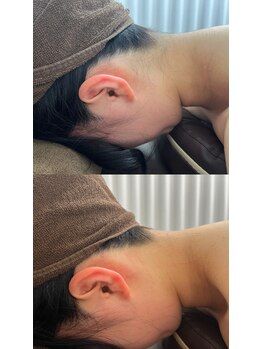 ミース 仙台長町店/うなじ矯正体験1回目!