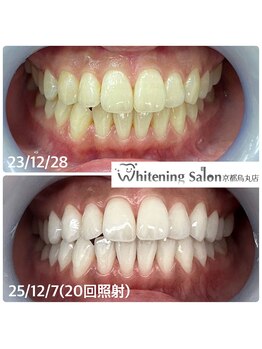 ホワイトニングサロン 京都烏丸店/ホワイトニング施術例