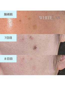 リシェル(Richelle)/【WHITELAB☆はがれるシミケア】