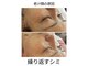 ソルズ(sol'z)の写真/湘南エリア唯一のマシーンミコステラ◎ダウンタイム、痛がない○施術直後から写真の通りの結果に☆