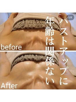 ルオント(LUONTO)/バストアップ症例