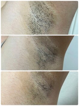 ノノ(nono)/ワキ脱毛！