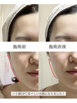 ハジュ(HAJU.)/フォト光フェイシャル