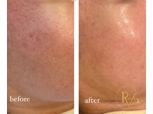 ラヴィス(RAVIS)/プロセル肌質改善