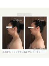 ハピア(HappiA)/小顔コルギ＋炭酸ガスペースト