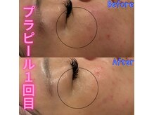 サンスエイジ(Sans age)の雰囲気（韓国最新ピーリング×毛穴洗浄【Before・After】）