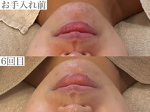 シーン(Sheen)/顎に出来る繰り返しニキビに