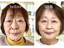 ピーチ鍼灸整体治療院(Peach鍼灸整体治療院)/最高級美容鍼/ヘッドスパ/リンパ