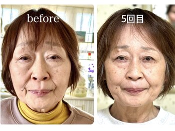 ピーチ鍼灸整体治療院(Peach鍼灸整体治療院)/最高級美容鍼/ヘッドスパ/リンパ