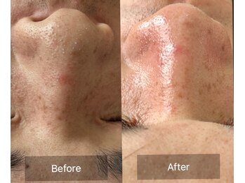 グリーンライツ(GREEN LIGHTS’)/毛穴スッキリコースbefore/after