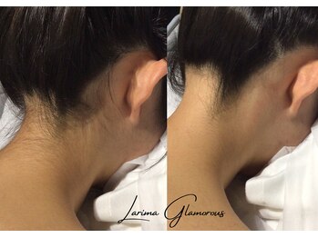 ラリマ グラマラス(Larima Glamorous)/小学生キッズ脱毛(男子・女子